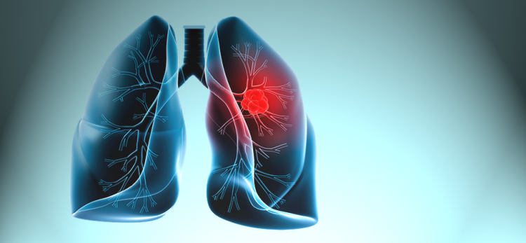 akciğer kanseri olduğunu öğrenmek