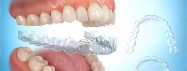 diş kaplamasının çıkması