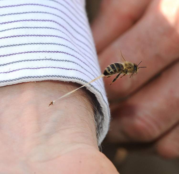 eşek arısı sokması
