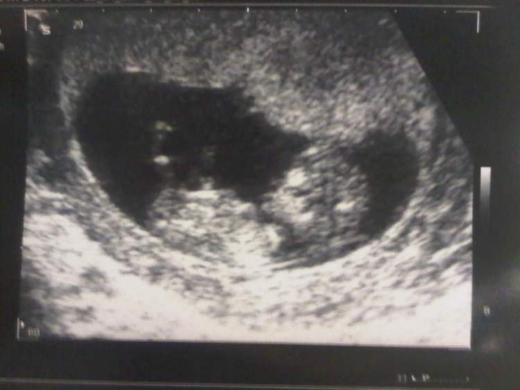 ultrasonda ikiz bebek görmek