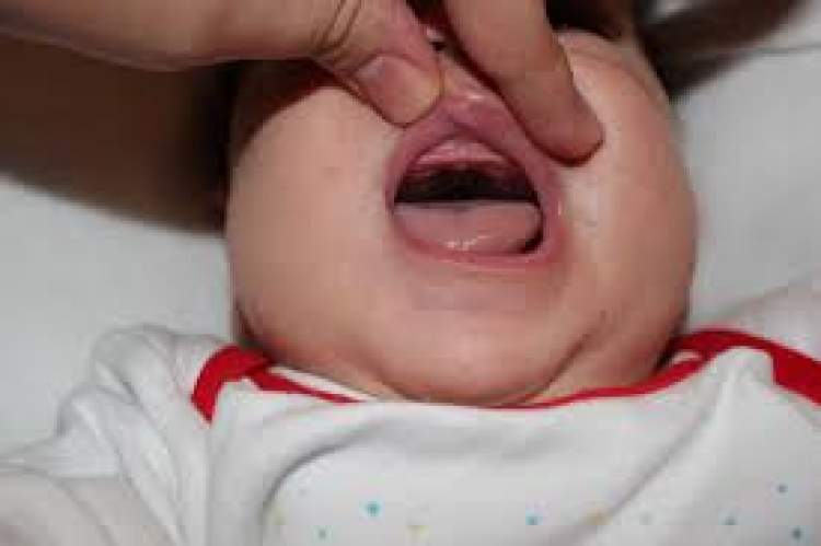 yeni doğan bebeğin dişlerinin olması