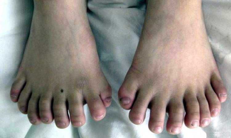 8 ayak parmağı görmek