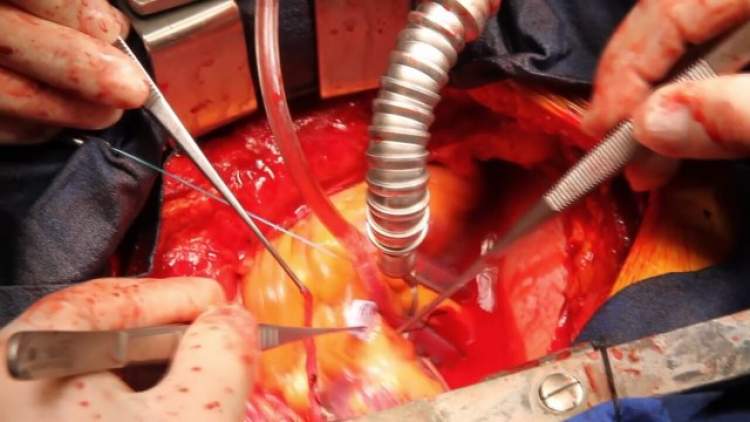 açık kalp ameliyatı görmek