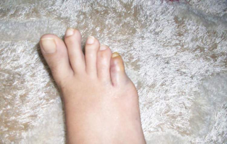 ayak parmaklarının kırılması