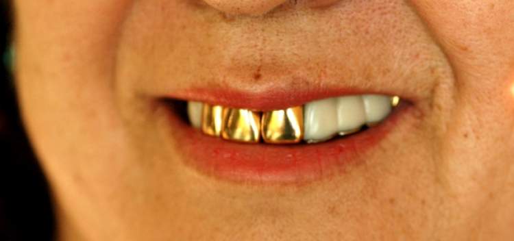 dişlerin altın olması