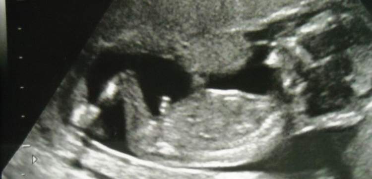 hamileyken ultrasonda erkek bebek görmek
